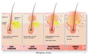 patogenesi dellacne - come si forma il brufolo