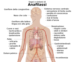 Signs_and_symptoms_of_anaphylaxis-IT